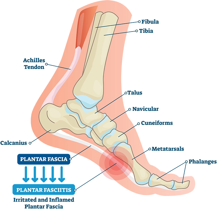 New treatment for plantar fasciitis 218 sales